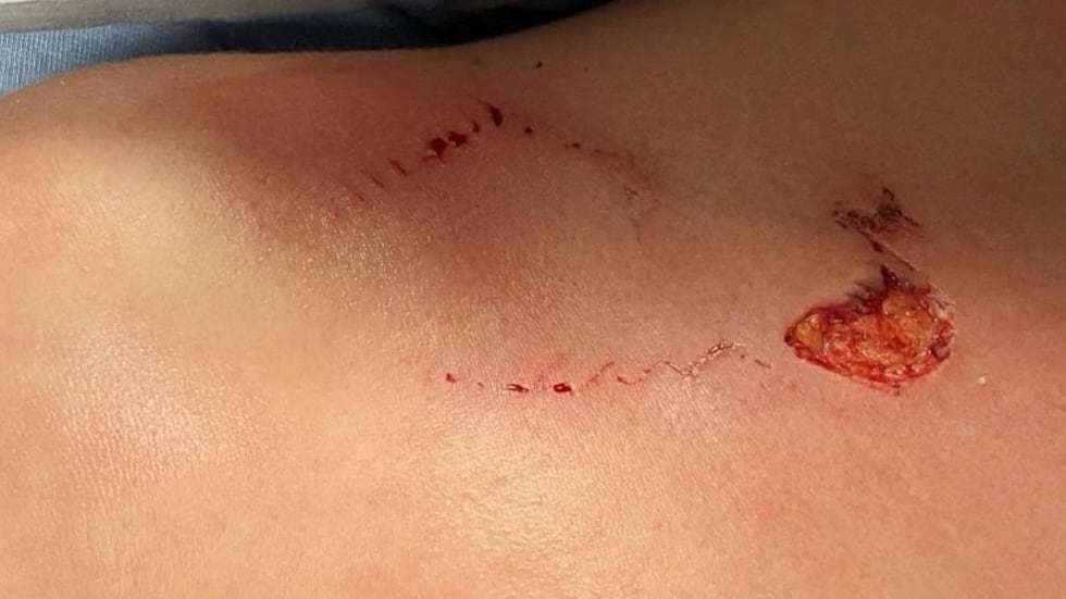 A bite received by a 9-year-old in Oak Island on Aug. 23, 2023